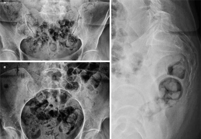 AP pelvis and lumbar radiograph reported as normal in a postpartum patient with sacral pain