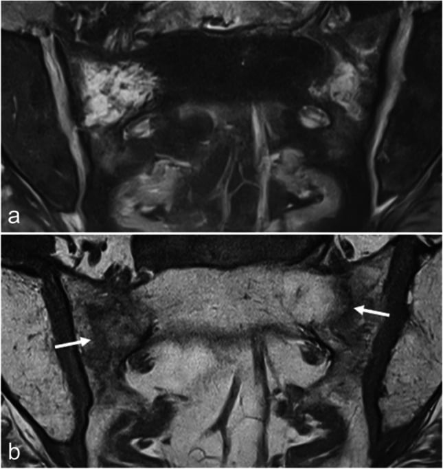 Coronal oblique FS T2 and T1 MRI showing sacral bone-marrow oedema and thin vertical sacral fracture lines
