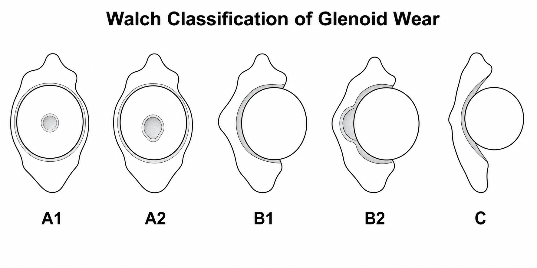 Axial diagram of the Walch glenoid classification types A1, A2, B1, B2 and C.