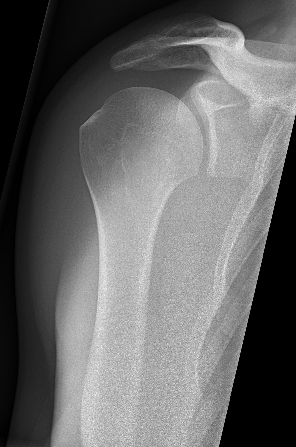 True AP (Grashey) radiograph of a normal shoulder showing the glenohumeral joint without overlap.