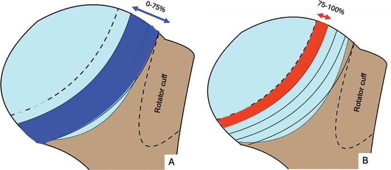 Axial MRI and 3D CT evaluation of Hill-Sachs lesion and glenoid track
