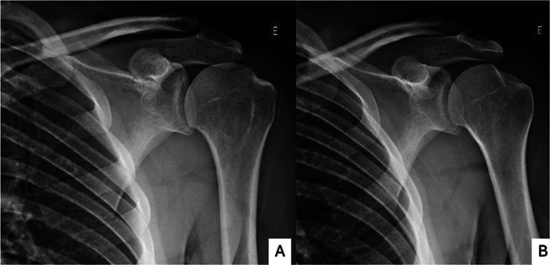 Radiographic series showing a Hill-Sachs lesion on four standard shoulder projections