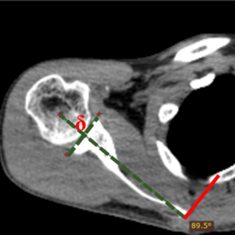 Axial CT scan of the scapula showing measurement of glenoid version angle
