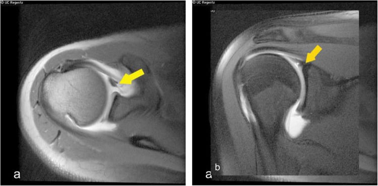 MR arthrogram of the shoulder demonstrating an anterior labral periosteal sleeve avulsion