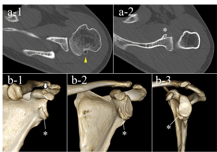 Axial CT and 3D reconstructions showing bony union of a glenoid fragment
