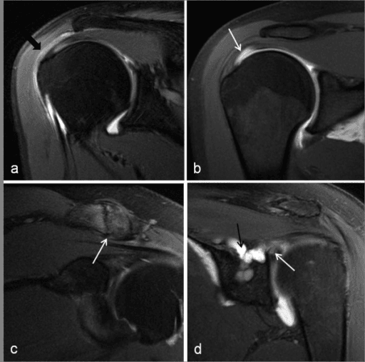 MR arthrogram showing subacromial bursitis and rotator cuff signal change