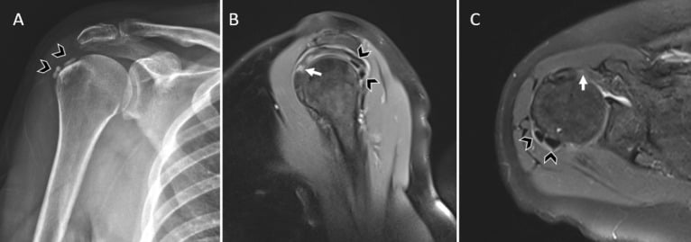 Plain radiograph and MRI demonstrating calcific tendinitis of the rotator cuff