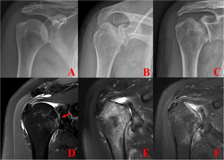 Serial radiographs and MRI demonstrating rapidly progressive destructive arthropathy