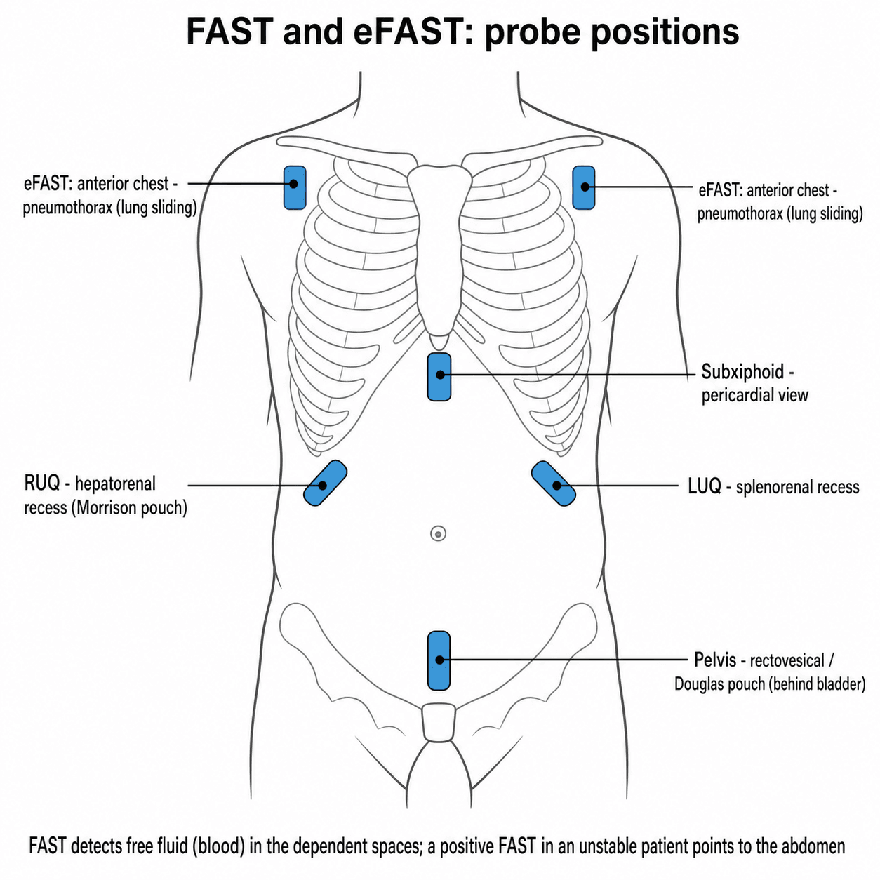 Torso diagram of the FAST and eFAST ultrasound probe positions: RUQ, LUQ, pelvis, subxiphoid and bilateral anterior chest