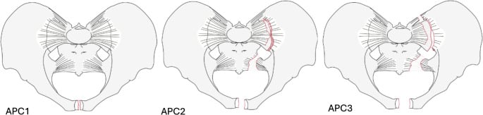 Line diagrams of Young-Burgess APC1, APC2 and APC3 pelvic ring injuries