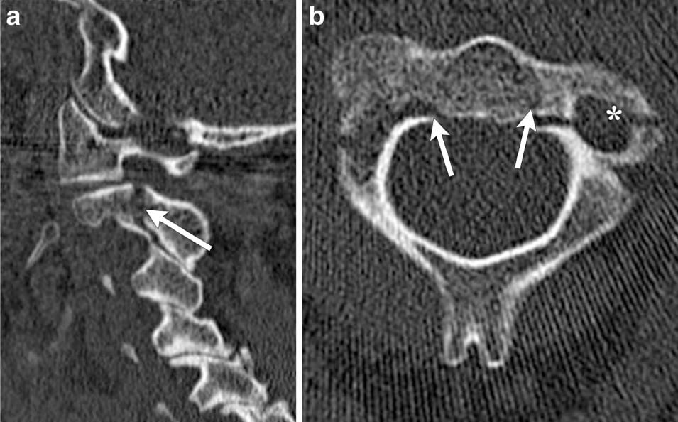 Sagittal and axial CT of a hangman's fracture with C2 pars breaks and C2-on-C3 anterolisthesis