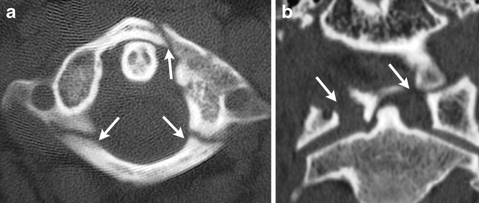 Axial and coronal CT of a Jefferson C1 burst fracture with anterior and posterior arch breaks and lateral-mass displacement