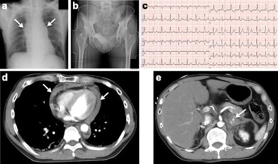 Five-panel trauma work-up: AP chest with a widened mediastinum, AP pelvis, ECG, chest CT and abdominal CT