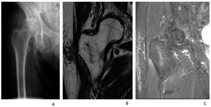 AP hip radiograph called normal, with coronal T1 and STIR MRI showing an intertrochanteric fracture
