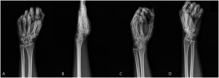 Four-view wrist series — AP, lateral, internal and external oblique — with no visible scaphoid fracture line