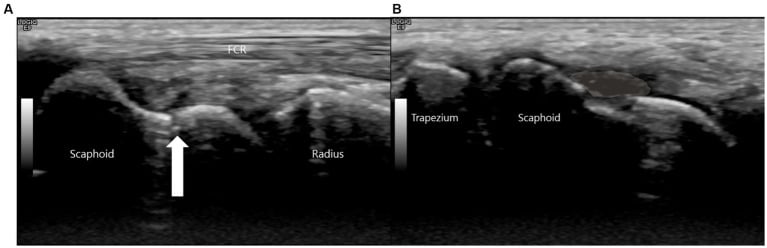 Longitudinal ultrasound of the scaphoid waist showing a cortical breach and an overlying haematoma