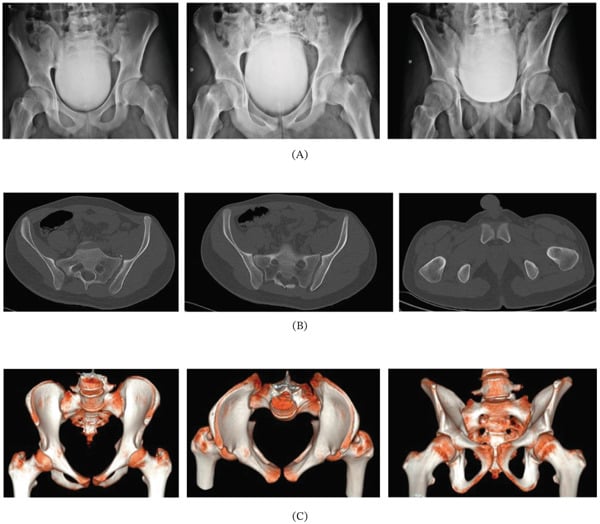 AP, inlet and outlet pelvis radiographs, axial CT of the sacrum and pubic symphysis, and 3D CT reconstructions