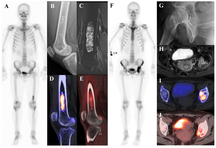 Radiograph, MRI, bone scintigraphy and PET-CT of an atypical cartilaginous tumour of the distal femur