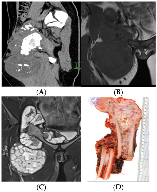 CT and MRI of a proximal femoral chondrosarcoma with internal calcification and soft-tissue extension