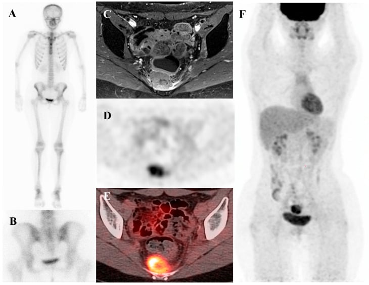Bone scintigraphy, MRI and FDG PET-CT in recurrent presacral Ewing sarcoma