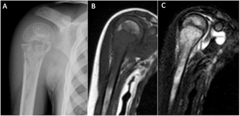AP radiograph and coronal T1 and STIR MRI of proximal humeral Langerhans cell histiocytosis