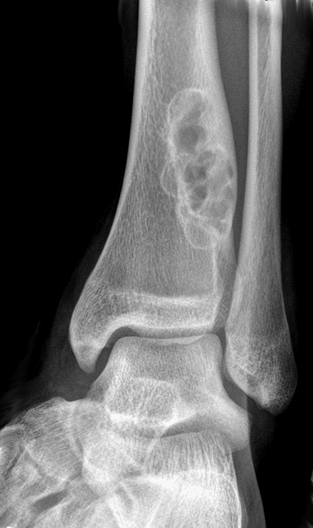 Ankle radiograph of a non-ossifying fibroma showing a geographic lytic lesion with a sclerotic rim