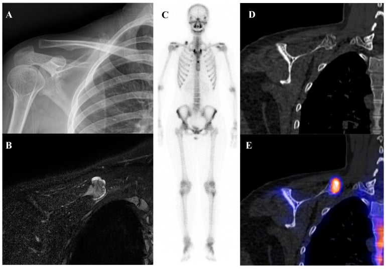 Radiograph, MRI, bone scintigraphy and CT of a scapular osteochondroma