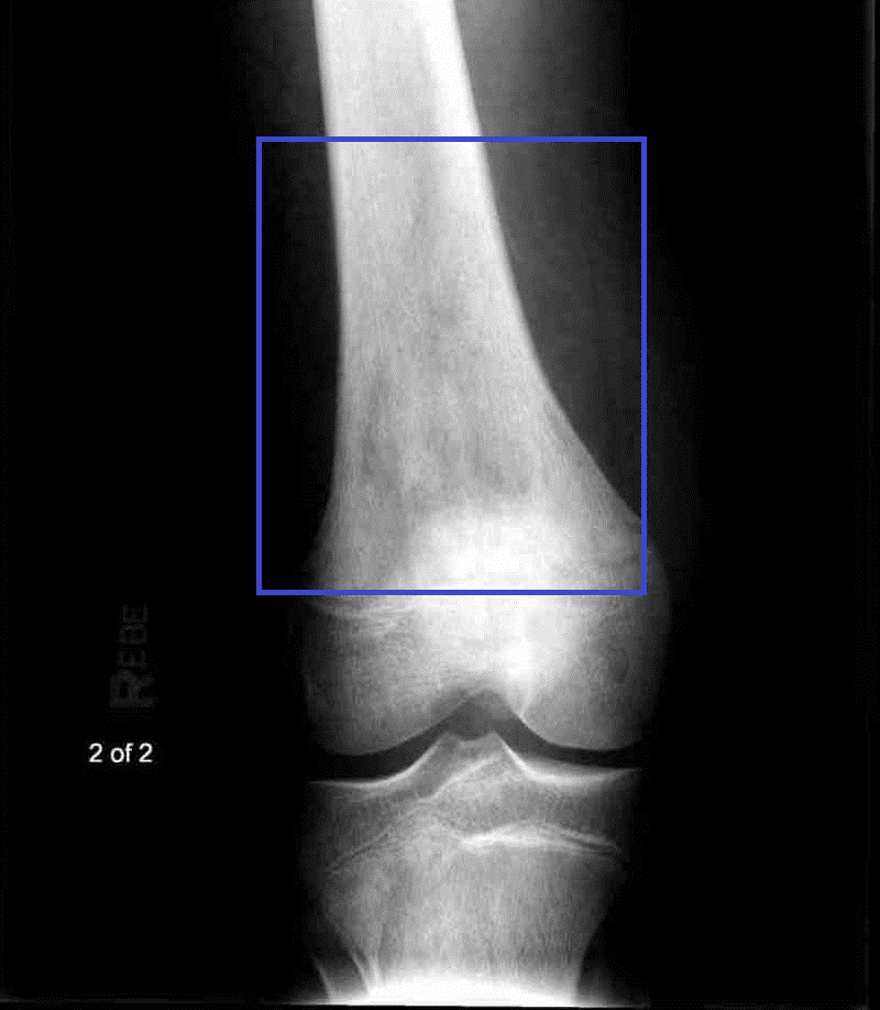 Radiograph of osteosarcoma of the distal femur showing an aggressive metaphyseal lesion