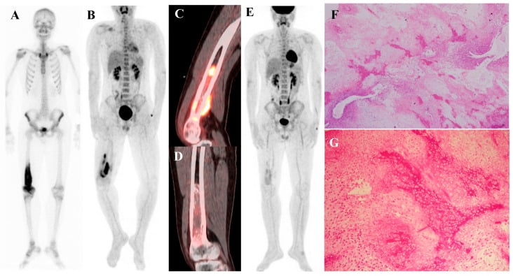 Multimodality staging images of a distal femoral osteosarcoma including bone scintigraphy and FDG PET-CT
