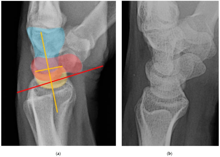 Lateral wrist radiograph with overlay showing a scapholunate angle near 90 degrees