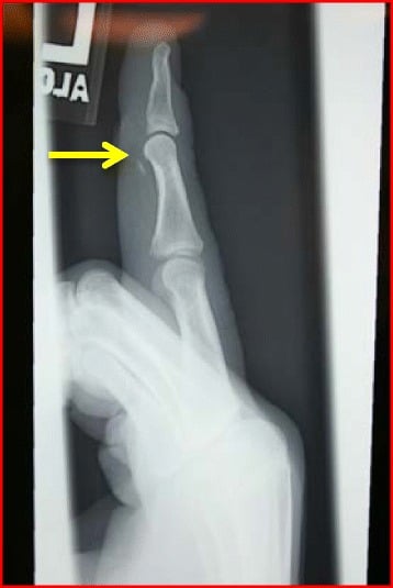 Lateral ring-finger radiograph showing an FDP bony avulsion fragment caught distal to the A4 pulley