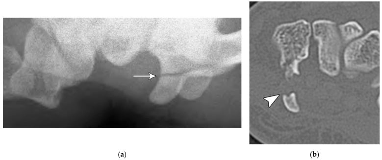 Carpal-tunnel radiograph and axial CT of a hook-of-hamate fracture