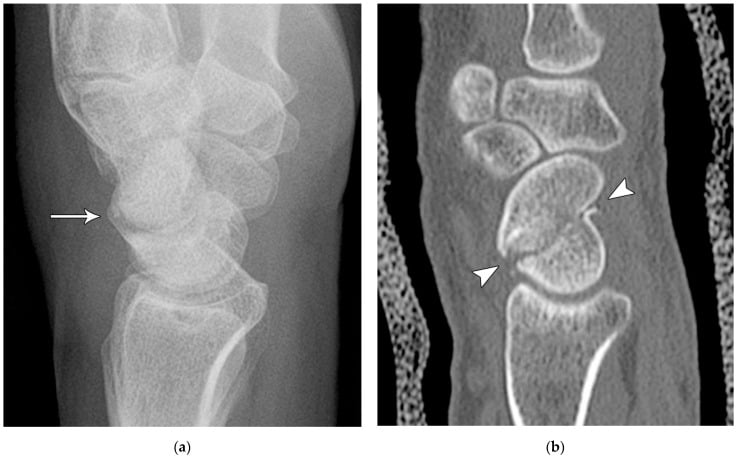 Lateral radiograph and sagittal CT of a scaphoid humpback deformity after fracture