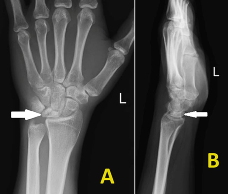 AP and lateral wrist radiographs showing lunate sclerosis, fragmentation and scaphoid rotation
