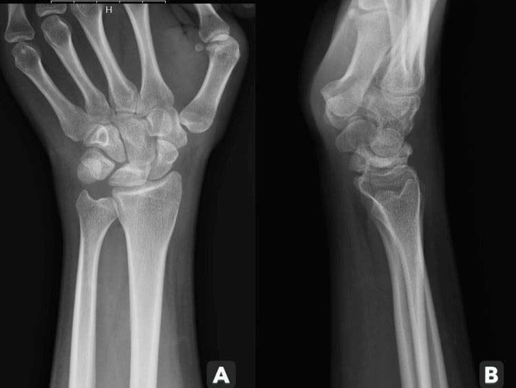 AP and lateral wrist radiographs showing early lunate sclerosis without collapse