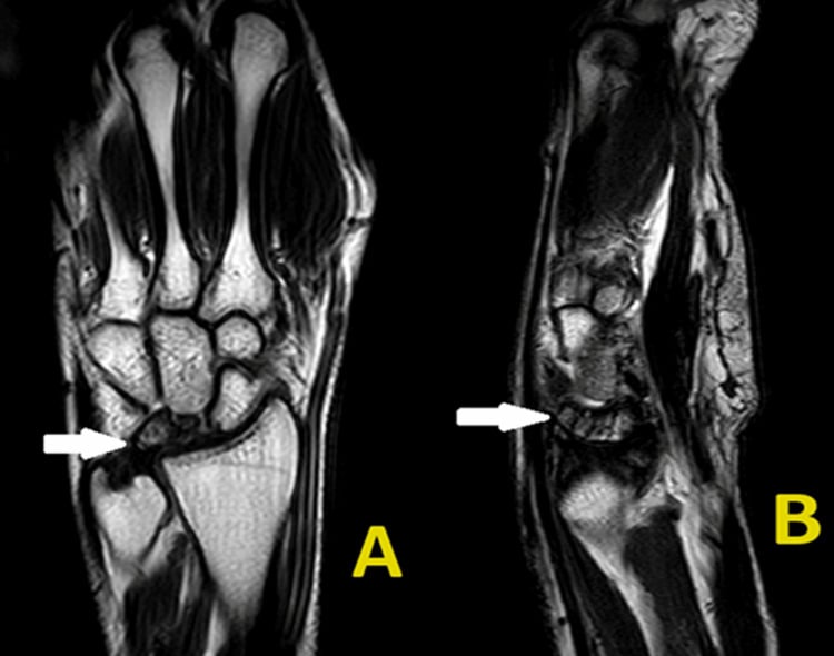 Coronal MRI of the wrist showing lunate collapse, marrow oedema and early chondral loss at the radius and capitate
