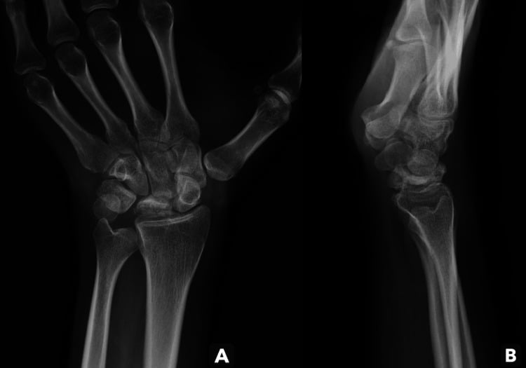 AP and lateral wrist radiographs three years later showing progression of lunate collapse