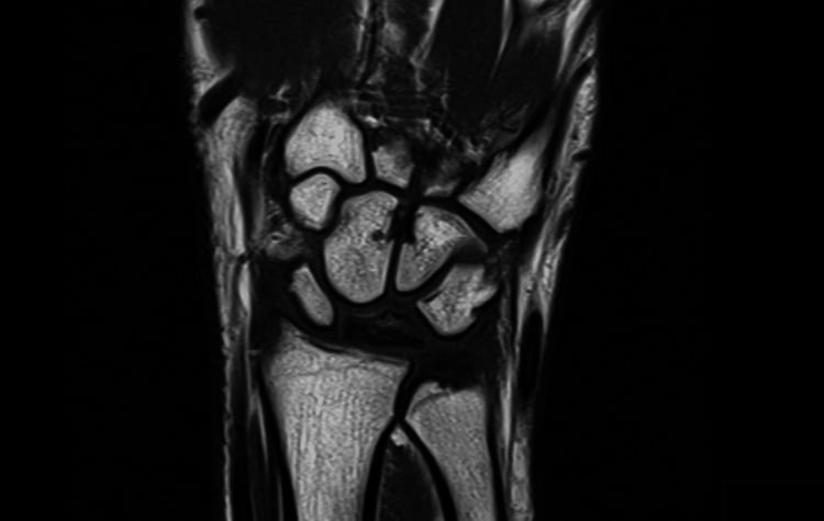 Coronal T1-weighted MRI showing diffuse hypointensity throughout the lunate