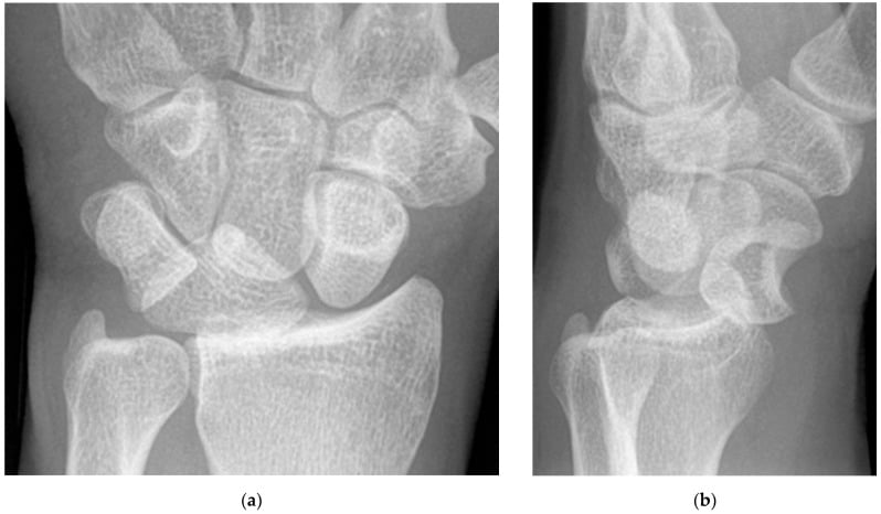 PA wrist radiograph showing the piece-of-pie sign and lateral radiograph showing a spilled-teacup volar lunate dislocation