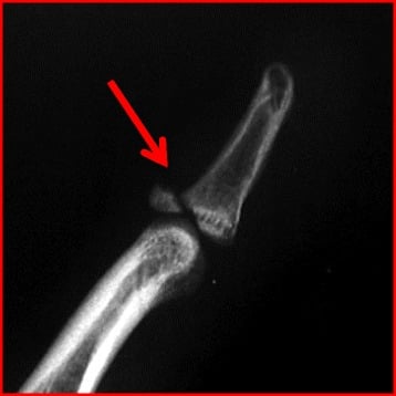 Lateral finger radiograph showing a bony mallet avulsion from the dorsal base of the distal phalanx