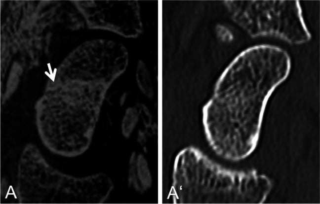 Parasagittal inverted 3D T1 GRE MRI showing a scaphoid fracture that is not clearly seen on the paired CT