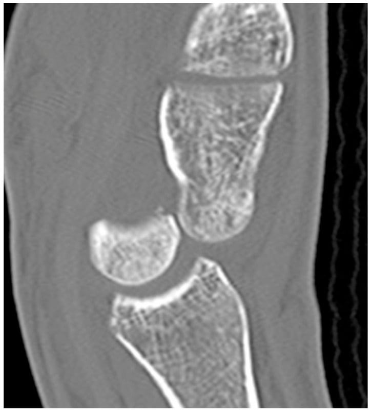Sagittal CT of the wrist showing dorsal dislocation of the capitate in stage II perilunate injury