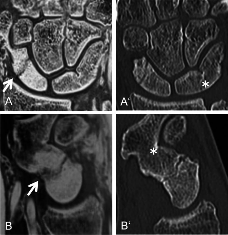 Coronal and parasagittal inverted 3D T1 GRE MRI next to matching CT reconstructions of an acute scaphoid fracture