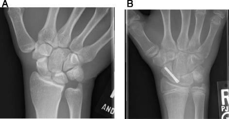 PA radiographs of a nondisplaced proximal-pole scaphoid fracture and a nondisplaced scaphoid-waist fracture