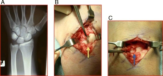 PA radiograph with a flexed scaphoid ring sign and intraoperative photographs of a complete scapholunate ligament tear