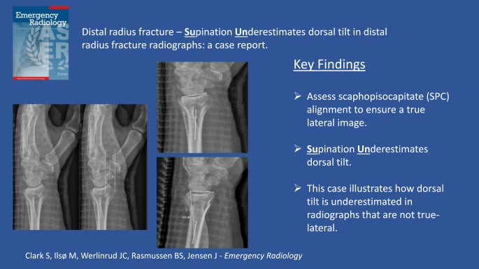 True lateral wrist radiograph showing scaphopisocapitate alignment with the pisiform over the central third of the scaphoid-capitate interval