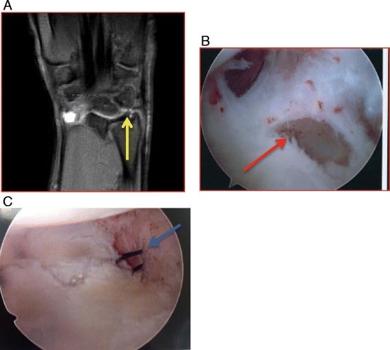 Coronal T2 MRI of an ulnar-sided peripheral TFCC tear with matching arthroscopic views