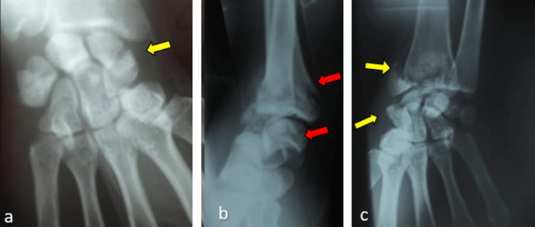 AP and lateral wrist radiographs of a trans-scaphoid retrolunar fracture-dislocation with an associated distal radius fracture