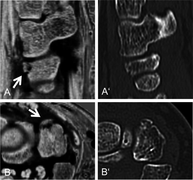 Sagittal and axial inverted 3D T1 GRE MRI next to matching CT of a dorsal triquetral avulsion fracture