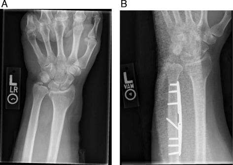 PA wrist radiographs showing 6 mm ulnar-positive variance before and neutral-to-negative variance after ulnar shortening osteotomy